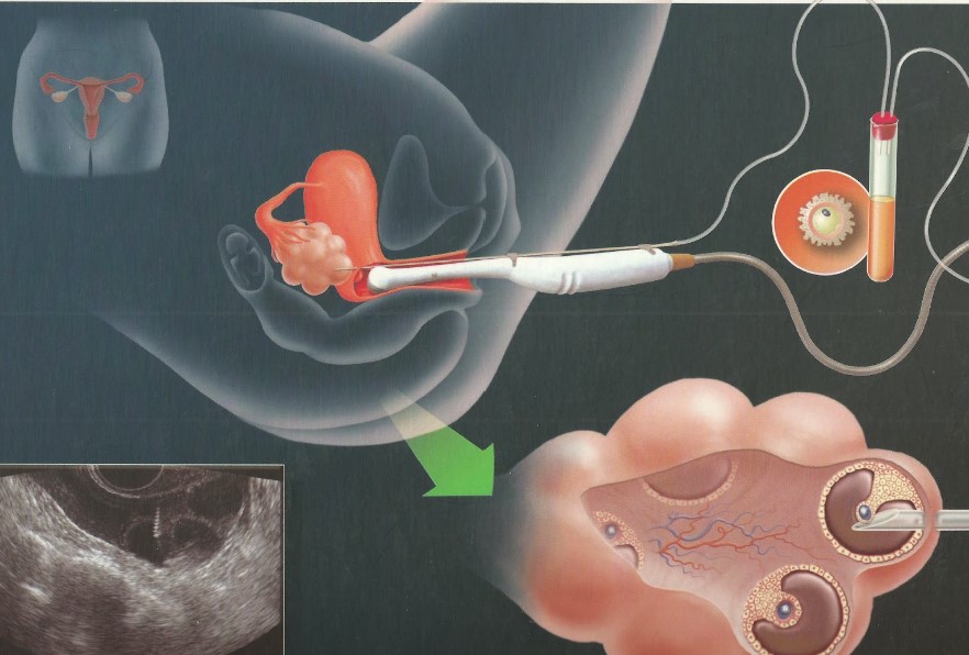 试管取卵后如何预防卵巢过度刺激综合征