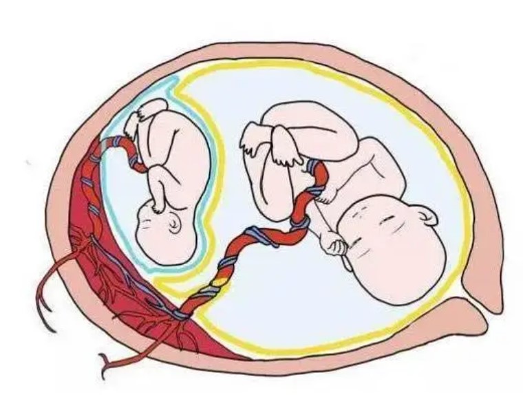试管移植为什么鲜胚移植容易出现双胎 